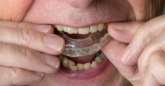 How Night Guards Prevent Bruxism Damage